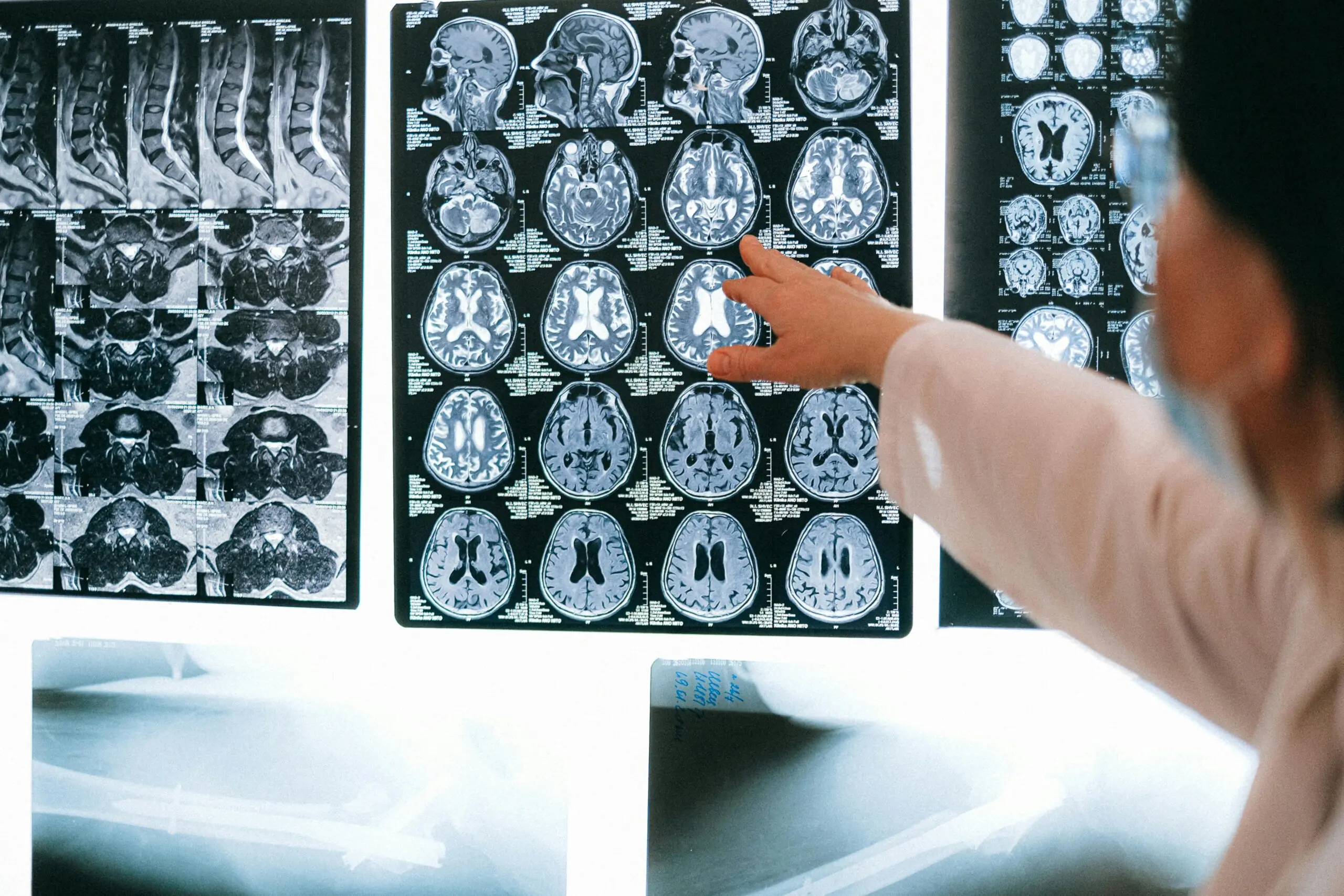 A doctor points to MRI scans on a lit wall.